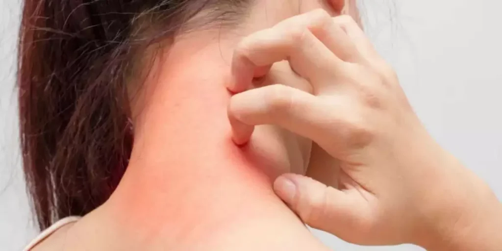 Why Are You Allergic to Hair Weaves? Safe Treatment Methods 10 Allergic to Weave