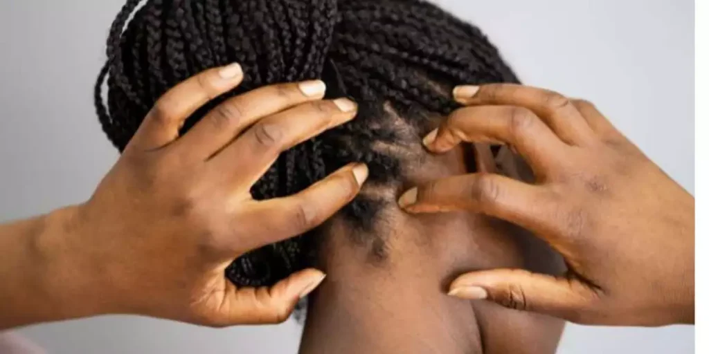 Why Are You Allergic to Hair Weaves? Safe Treatment Methods 11 Allergy to Weave